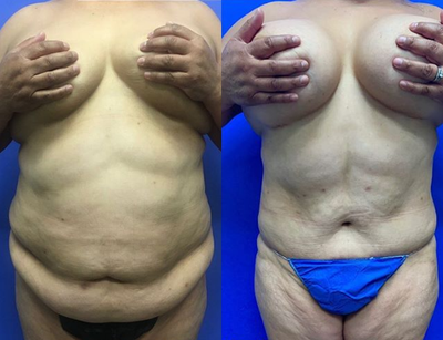 Case 1715 - Woman treated with Tummy Tuck