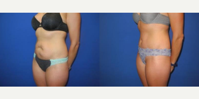 Case 1716 - Woman treated with Tummy Tuck