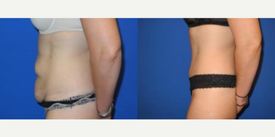 Case 1717 - Woman treated with Tummy Tuck