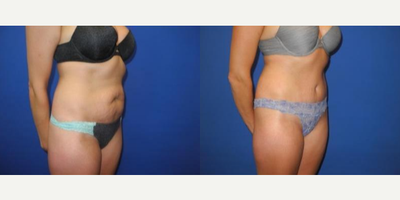 Case 1718 - Woman treated with Tummy Tuck