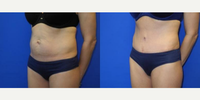 Case 1720 - Woman treated with Tummy Tuck