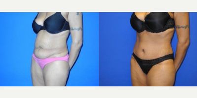 Case 1721 - Woman treated with Tummy Tuck