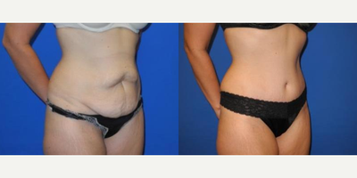 Case 1723 - Woman treated with Tummy Tuck