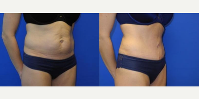 Case 1724 - Woman treated with Tummy Tuck