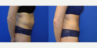 Case 1725 - Woman treated with Tummy Tuck