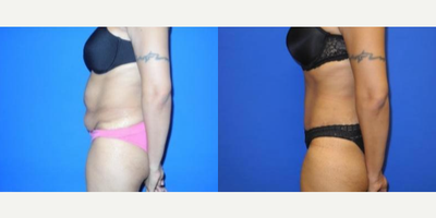 Case 1726 - Woman treated with Tummy Tuck