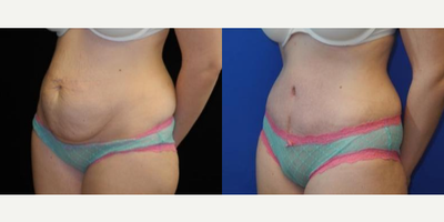 Case 1727 - Woman treated with Tummy Tuck