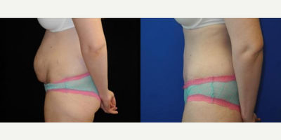 Case 1728 - Woman treated with Tummy Tuck