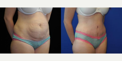 Case 1729 - Woman treated with Tummy Tuck