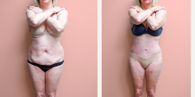 Case 173 - 55-64 year old woman treated with Tummy Tuck, Tumescent Liposuction