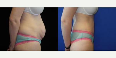 Case 1730 - Woman treated with Tummy Tuck