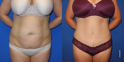 Case 1731 - Tummy Tuck