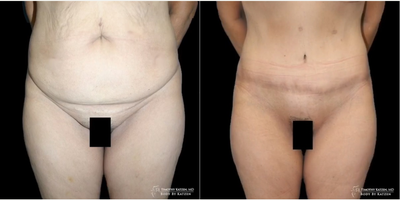 Case 1754 - Woman treated with Tummy Tuck