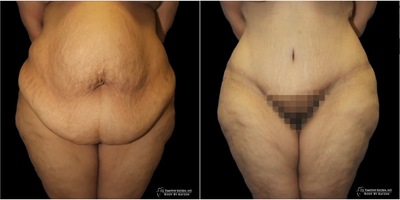 Case 1755 - Woman treated with Tummy Tuck