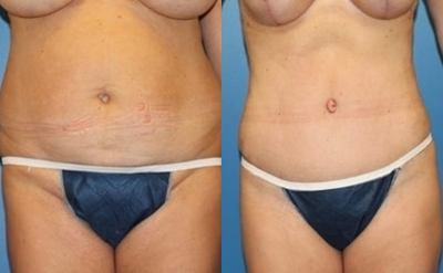 Case 1759 - Tummy Tuck