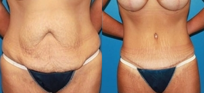 Case 1760 - Tummy Tuck