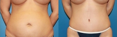 Case 1761 - Tummy Tuck