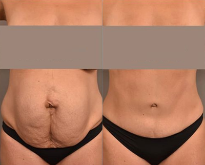 Case 1762 - Woman treated with Tummy Tuck