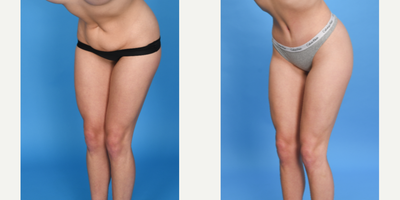 Case 1765 - 25 year old woman treated with Tummy Tuck