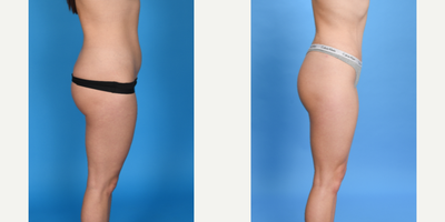 Case 1766 - 25 year old woman treated with Tummy Tuck