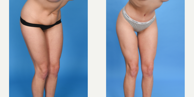 Case 1767 - 25 year old woman treated with Tummy Tuck