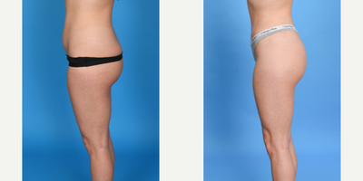 Case 1768 - 25 year old woman treated with Tummy Tuck