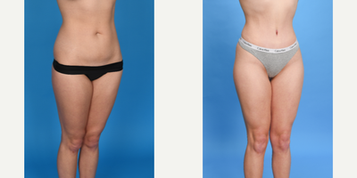 Case 1769 - 25 year old woman treated with Tummy Tuck