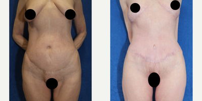 Case 177 - 65-74 year old woman treated with Tummy Tuck