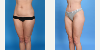 Case 1770 - 25 year old woman treated with Tummy Tuck