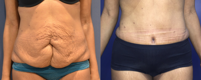 Case 1771 - 35-44 year old woman treated with Tummy Tuck