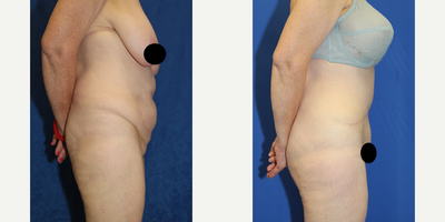 Case 1774 - 55-64 year old woman treated with Tummy Tuck