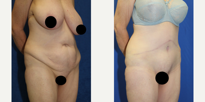 Case 1775 - 55-64 year old woman treated with Tummy Tuck