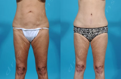 Case 1777 - Woman treated with Tummy Tuck