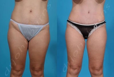 Case 1778 - Woman treated with Tummy Tuck