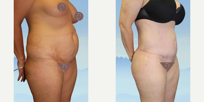 Case 1779 - 35-44 year old woman treated with Tummy Tuck