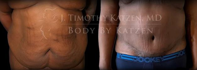 Case 1784 - Man treated with Tummy Tuck