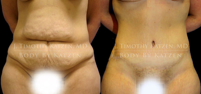 Case 1785 - Woman treated with Tummy Tuck