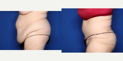 Case 1786 - 55-64 year old woman treated with Tummy Tuck