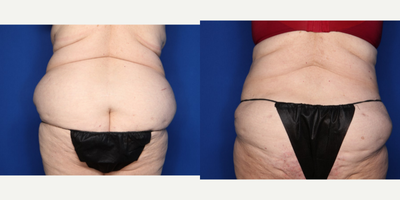 Case 1787 - 55-64 year old woman treated with Tummy Tuck