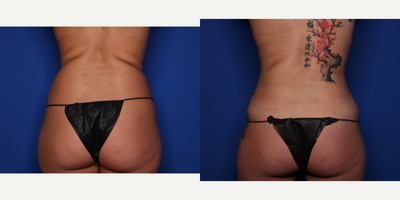 Case 1789 - 45-54 year old woman treated with Tummy Tuck