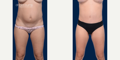 Case 179 - Woman treated with Tummy Tuck