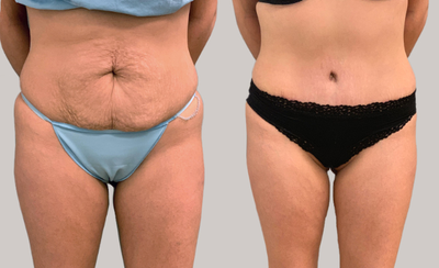 Case 1791 - 35-44 year old woman treated with Tummy Tuck