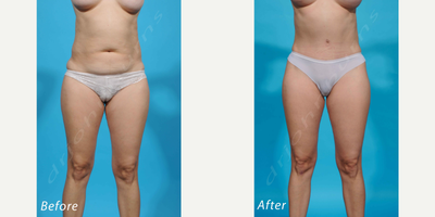 Case 1792 - 25-34 year old woman treated with Tummy Tuck