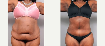 Case 1793 - Patient treated with Tummy Tuck