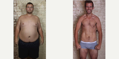 Case 1794 - Patient treated with Tummy Tuck