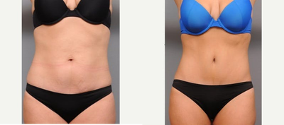 Case 1795 - Patient treated with Tummy Tuck