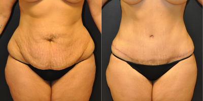 Case 1796 - 40 year old woman treated with Tummy Tuck