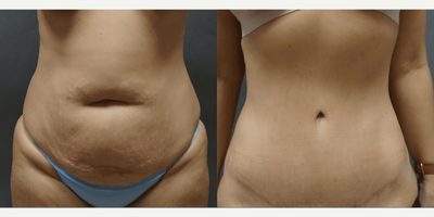 Case 1797 - Woman treated with Tummy Tuck