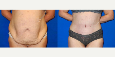 Case 1798 - Woman treated with Tummy Tuck