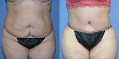 Case 1799 - 25-34 year old woman treated with Tummy Tuck